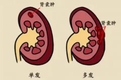 武汉十大名老中医徐长化教授：左肾囊肿腰酸痛反复发作身困乏力口干用什