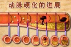 武汉中医疑难杂症专家向贤德教授：下肢动脉硬化性闭塞症左下肢及足趾痛