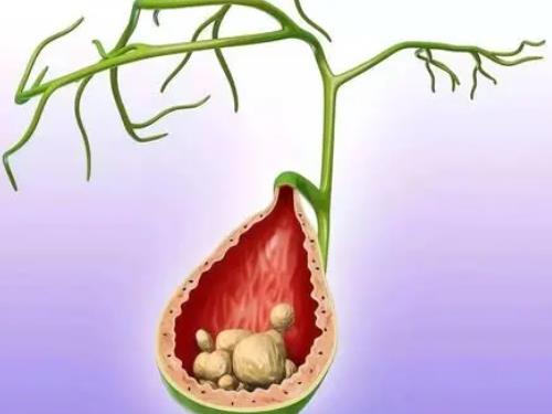 肝内胆管结石病右胁疼痛反复发作10年3天前再发怎么治好?