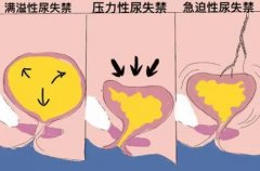 武汉名老中医门诊鲁本堂：压力性尿失禁2年稍一用力即小便失禁手麻腰酸中
