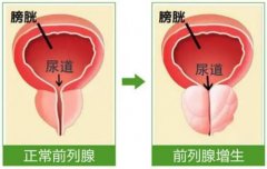 武汉中医男科鲁本堂：前列腺增生伴慢性前列腺炎会阴胀痛2年，腹痛腰酸尿