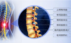 腰痛牵连腿疼腿麻是腰椎间盘突出症吗？诚顺和老中医孔政可以治疗吗？