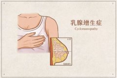 武汉中医内妇科肖早梅：乳房有肿块疼痛在经期加重有哪些中药方子治疗？