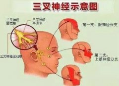 武汉针灸专家中医王垚：原发性三叉神经痛左面颊部疼痛3年，每日发作20次