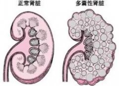 湖北省黄冈市名老中医徐长化教授：双侧多囊肾3年，近1年肾功能异常泡沫