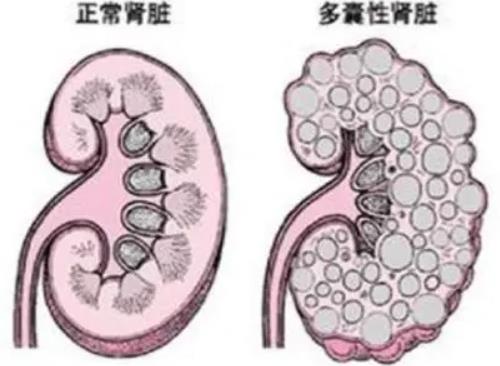 湖北省黄冈市名老中医徐长化教授：双侧多囊肾3年，近1年肾功能异常泡沫尿怎么治疗？