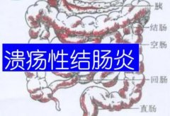 汉口中医内科专家门诊王垚主任：溃疡性结肠炎6年，大便带血色暗红怎么治