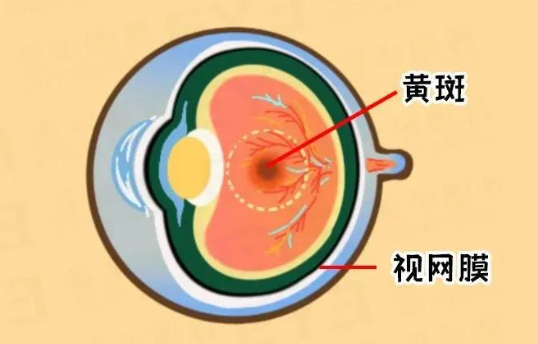 老年性黄斑病变怎么治疗？