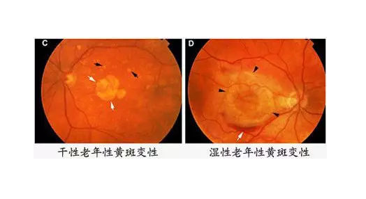 老年性黄斑病变中医治疗医案