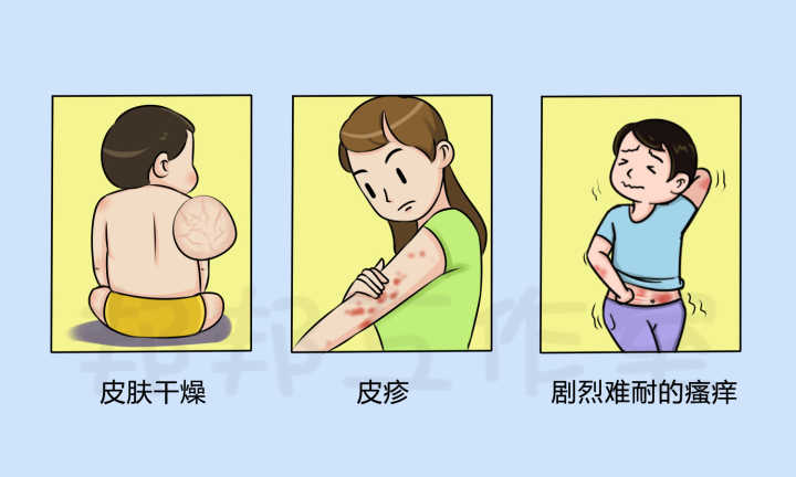 泛发性湿疹怎么治疗效果好？