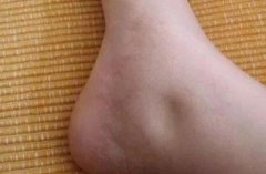 鄂州名老中医徐长化教授：双下肢水肿，尿蛋白2+阳性半年，吃什么中药能