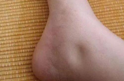 鄂州名老中医徐长化教授：双下肢水肿，尿蛋白2+阳性半年，吃什么中药能消肿、转阴？