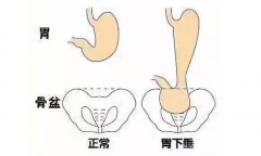 荆州市名老中医张压西：胃下垂胃胀隐痛嗳气不舒饭后加重怎么治疗效果好