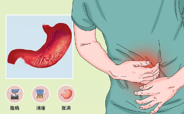 脘腹痞满嗳气反酸怎么治疗？