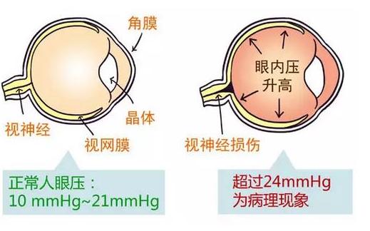 青光眼中医治疗医案