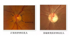 孝感市眼病治疗专家丁辛博士：视神经萎缩看东西模糊视力明显下降怎么办