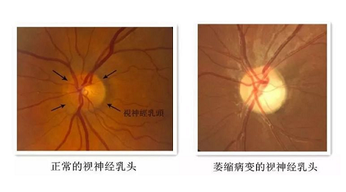 视神经萎缩视物模糊怎么治疗？