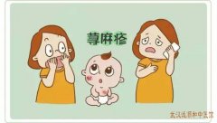 儿科疑难杂症专家王大宪：小儿慢性荨麻疹发作不固定时消时长中医怎么治