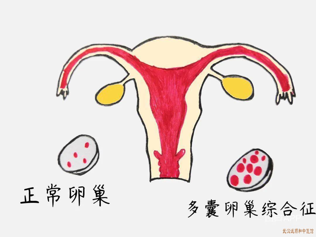 多囊卵巢综合症患者在生活上要注意什么？ - 知乎