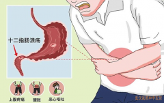 武汉脾胃调理老中医张林茂：十二指肠溃疡胃脘胀痛并嗳气吐酸中医怎么治