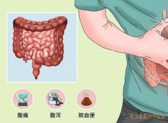 脾胃病名中医张林茂：溃疡性结肠炎腹泻腹痛明显偶有带血便反复不愈怎么