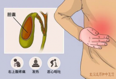 武昌内科专家张压西：慢性胆囊炎右上腹部疼痛明显中医保守治疗能好吗？