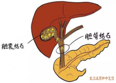 肝胆疾病治疗专家张林茂：胆石症右侧上腹部疼痛恶心呕吐喝中药有用吗？