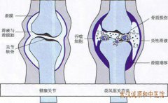 疼痛门诊宋跃进教授：全身多处关节疼痛活动受限天冷加剧难以忍受吃什么