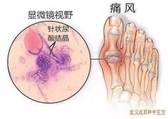 武汉有名的风湿骨痛专家宋跃进：多食海鲜引发痛风反复发作1年久治不愈中