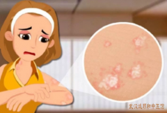 皮肤科胡爱玲：手臂小腿处银屑病泛发全身躯干各处中医怎么控制皮损？