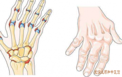 骨伤疼痛科专家孔政：手指关节肿胀变形类风湿关节炎中医治疗后诸症改善