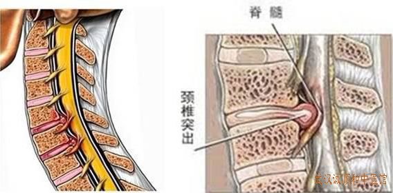 湖北疼痛骨科老中医柳新樵：颈6-7椎体边缘唇状骨质增生反复持续性头晕中医怎么治?