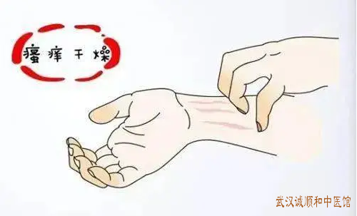 老年性皮肤瘙痒症中医胡爱玲治疗医案一则