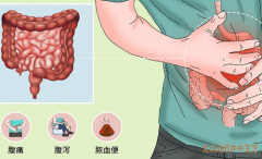长期便秘腹泻大便时肛门灼热不畅，中医张林茂治疗溃疡性结肠炎医案一则