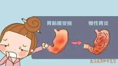 武汉调理胃肠疾病有名的中医张林茂：治疗慢性胃炎合并胃溃疡医案一则
