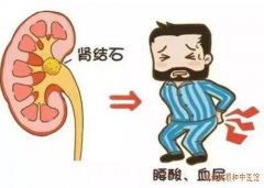 武汉中医李家发教授：肾结石阵发性左侧腰部隐痛血尿痛吃什么中药能打下