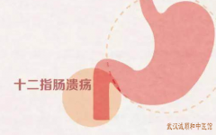 武汉厉害的肠胃病中医张压西：十二指肠溃疡腹痛难忍服用中药治疗医案