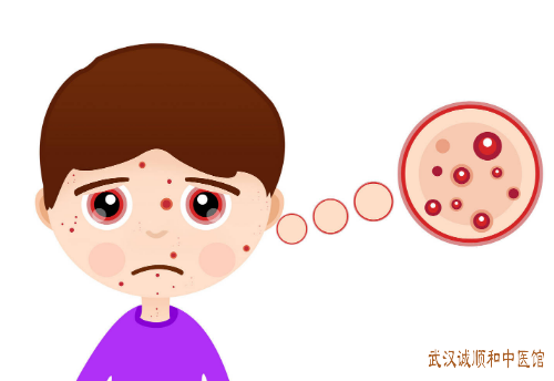 面部湿疹反复中医中药治疗医案一则