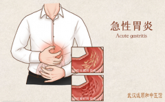 武昌看胃病厉害的专家张压西：急性胃炎胃痛胃胀胸闷嗳气中医治疗见效快
