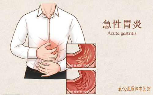 急性胃炎胃痛胃胀中医治疗医案