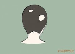 武汉治脱发推荐王儒英教授：头顶部出现斑状脱发脱发处头皮光亮中医治疗