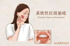 中医宋跃进坐诊时间?系统性红斑狼疮头晕耳鸣脱发闭经1年中医怎么治?