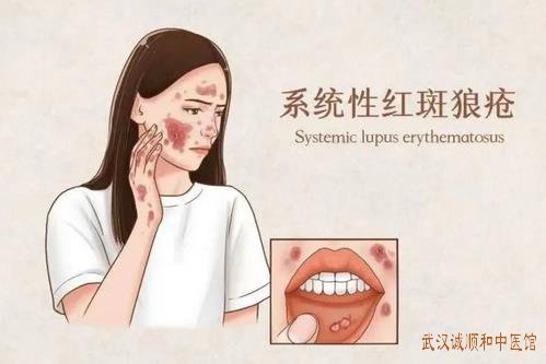 中医宋跃进坐诊时间?系统性红斑狼疮头晕耳鸣脱发闭经1年中医怎么治?