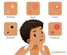 皮肤科主任王儒英：双手部泛发米粒至黄豆大小丘疹轻度瘙痒中医怎么祛疣