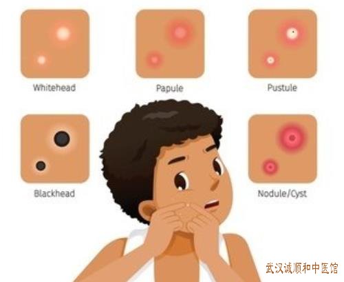 皮肤科主任王儒英：双手部泛发米粒至黄豆大小丘疹轻度瘙痒中医怎么祛疣平赘?