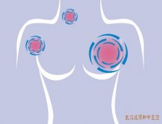 武汉中医馆肿瘤有名专家刘玉茂：乳腺恶性肿瘤化疗后乏力头晕伴无力怎么