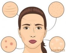 湖北省中医院原皮肤科主任王儒英：口周水疱伴疼痛反复发作中医怎么治疗