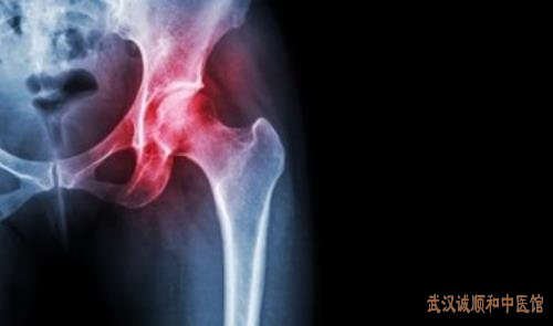武汉疼痛门诊老中医柳新樵：脾虚多湿平素表虚易汗有风湿性关节炎中医怎么治?