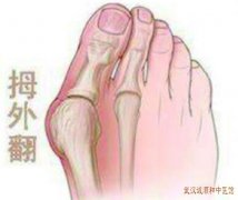 武汉有名老中医治疗风湿骨病宋跃进：类风湿性关节炎下肢关节疼痛吃中药