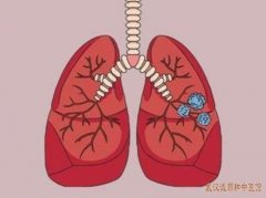武汉街道口肺结节中医治疗专家钟明：肺部多发结节乏力伴心烦急躁中药怎